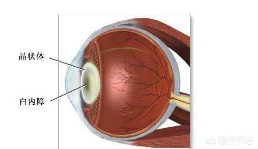 得白内障的原因:父母得白内障，子女会得白内障吗？
