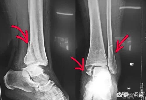 脚踝骨裂的症状怎样治愈:脚踝骨裂医生就帮我打了石膏能好吗？