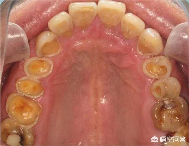 口腔上方内壁疼痛可以喝水,口腔左上方内壁疼痛
