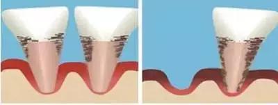 牙结石症状:牙结石症状图片 口腔不健康，牙齿松动会导致什么症状？