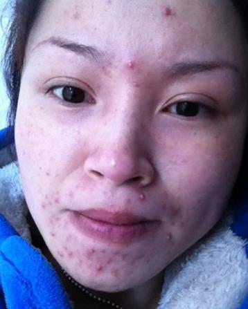 头条问答 - 满脸痔疮,月经量少,推迟,这是怎么了?(2个回答)