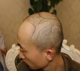 植发有后遗症吗(植发会不会有什么后遗症)