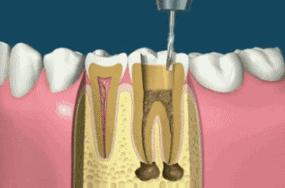根管治疗后牙疼(根管治疗后牙齿的寿命)