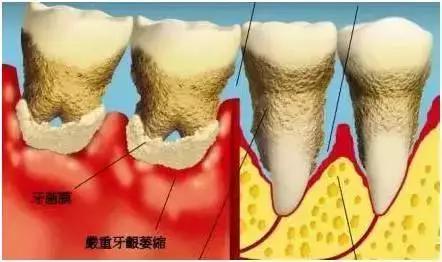 牙结石症状:牙结石症状图片 口腔不健康，牙齿松动会导致什么症状？