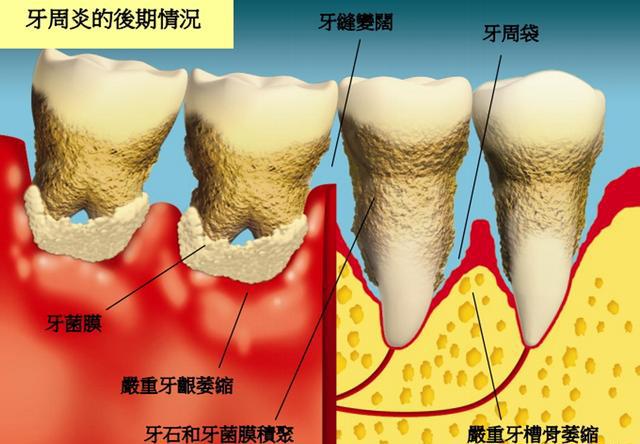 通过洗牙去除牙石后,牙齿暴露在久违的外界环境内,会产生种种异样的