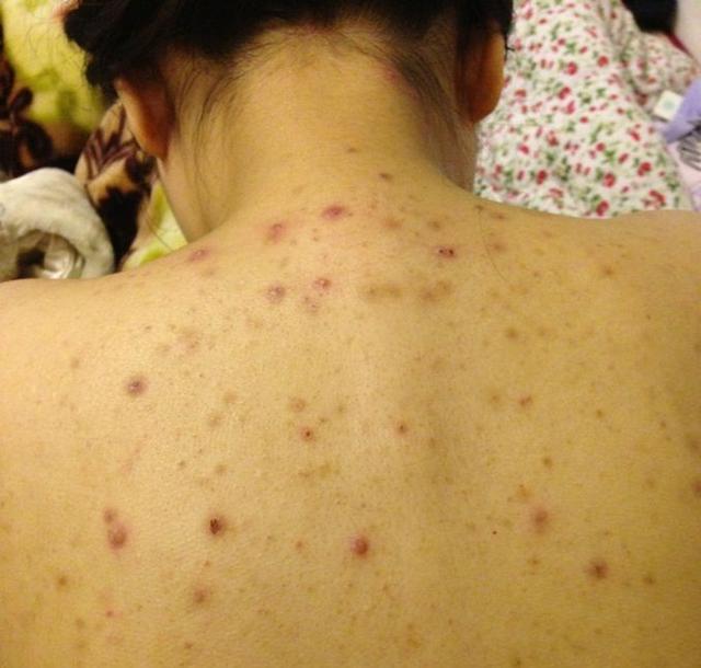 后背为什么会长痘痘为什么后背会长小疙瘩痘痘