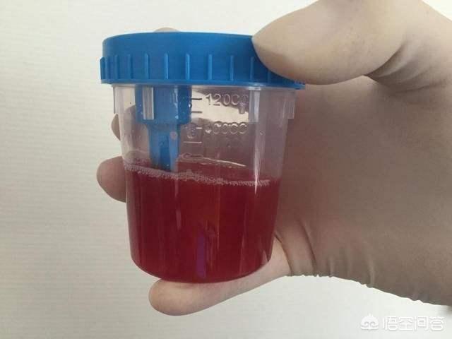 尿液有红色沉淀物图片图片
