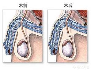 什么是男性绝育手术:谁知道知道男人结扎手术怎么做？有什么影响？精液去哪儿了？