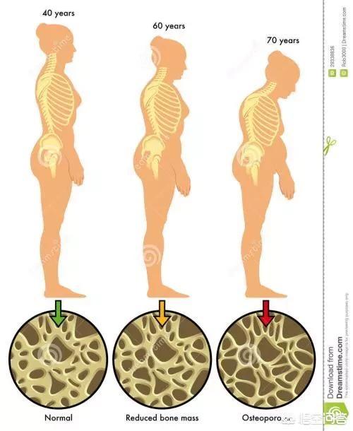 骨质疏松和缺钙的原因:骨质疏松和缺钙是一回事吗？