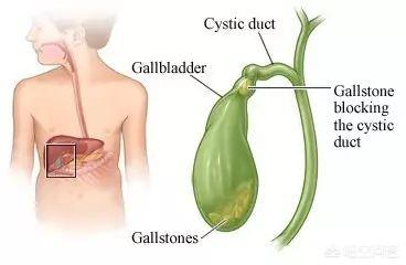 梦到自己得了胆囊炎,胆囊炎是怎么引起的，吃什么水果比较好？