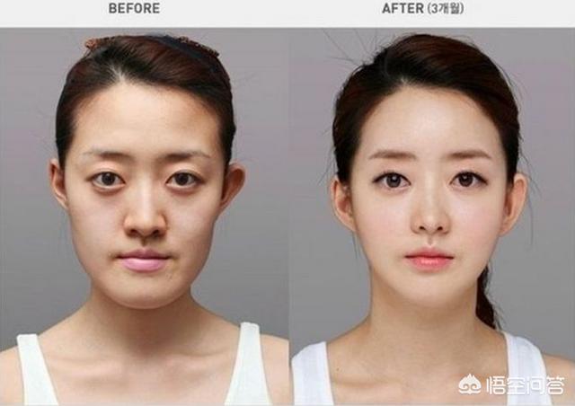 罗霈颖整容对比照:在韩国整容是不是很普遍的事情？