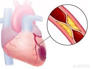 为什么近几十年来，患糖尿病和高血压者越来越多