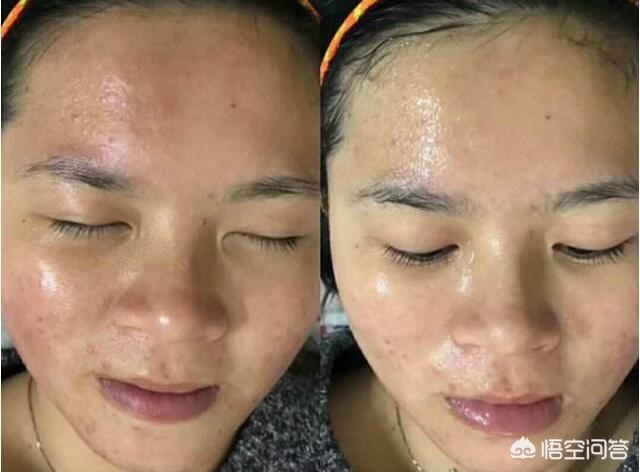 最近很流行的灌肤到底是什么,真的像大家说的那么神奇吗？