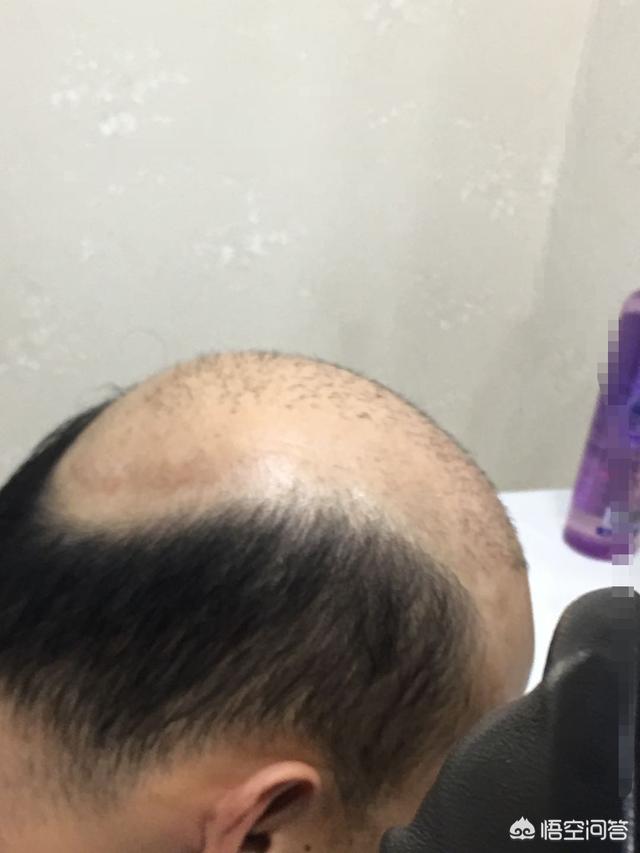 如果你秃顶了,植发,带假发,纹发你会选择哪一种？