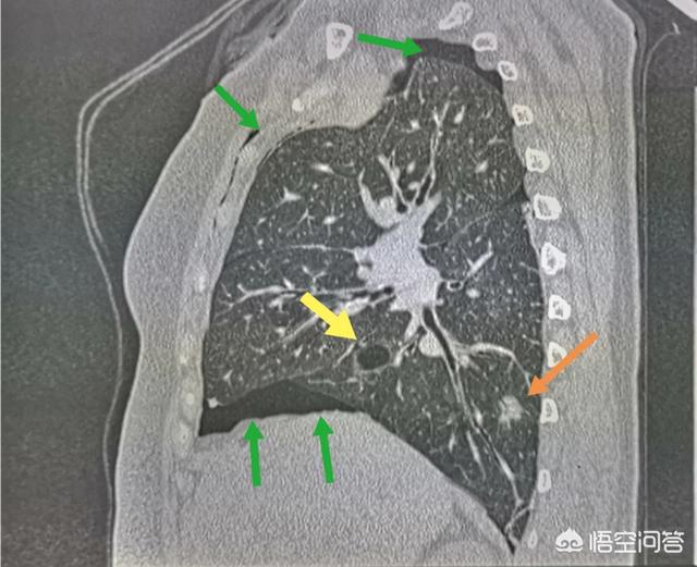 头条问答 气胸是怎么回事 23个回答