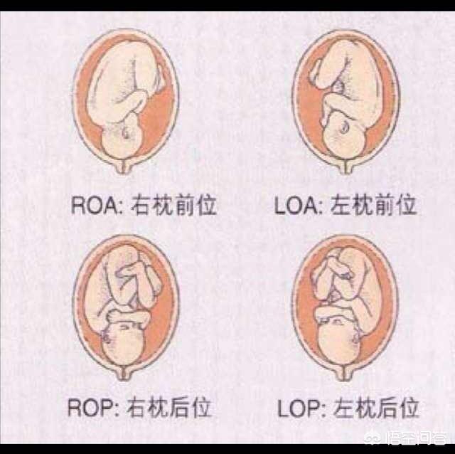 孕28周以前孕妈子宫内的空间充足,胎儿胎位可以自由变换.