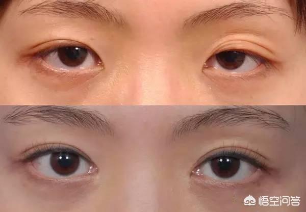 古巨基割双眼皮:对于男生割双眼皮你们怎么看