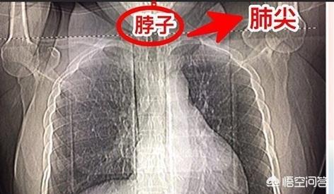 孕妇梦见戴红围脖是什么意思:做胸部CT一定要带防甲状腺辐射护脖吗？