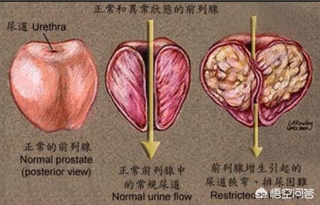 尿道结石症状:怎样确定是得了肾结石还是前列腺？