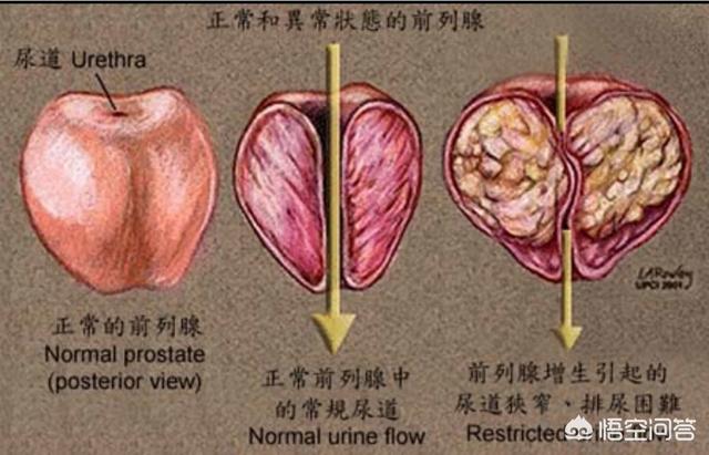 前列腺结石如何治疗(前列腺结石如何治疗方法)