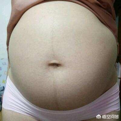 妊娠线:为什么怀孕5个月了还没有妊娠线？