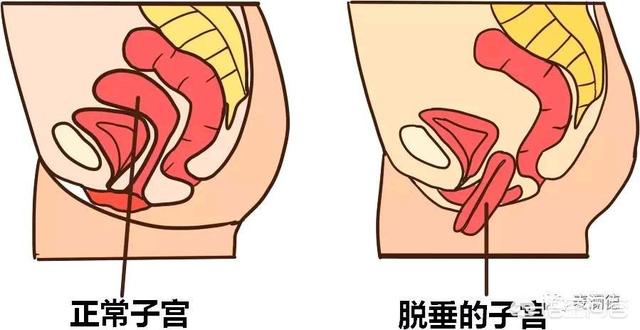 生完孩子盆底肌松弛有什么影响？