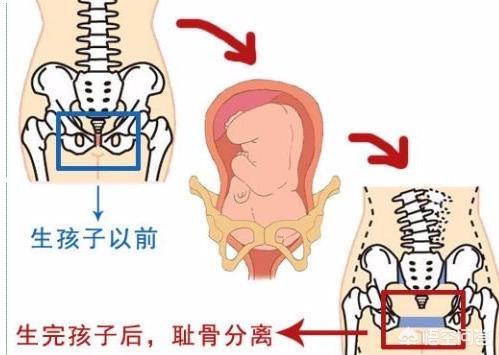 头条问答 所谓的孕妇耻骨痛应该是身体的哪个部位 怎么缓解 朵拉成长树的回答 0赞