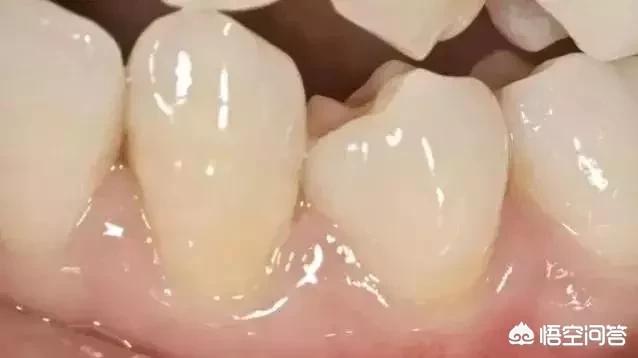 儿童四环素牙怎么治:儿童四环素牙怎么治疗 三岁小孩吃消炎药（头孢、阿奇、罗红霉素）一般几天一疗程？