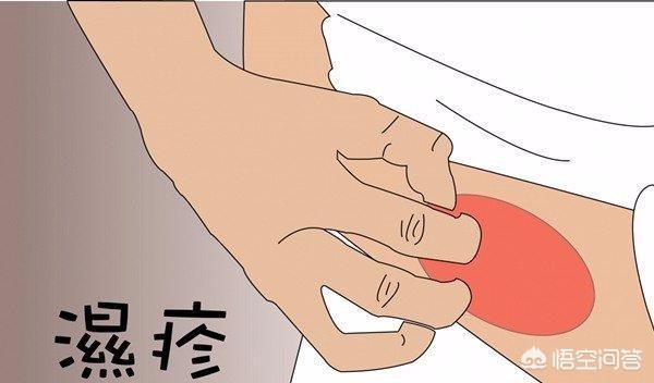 治疗湿疹最快的方法儿童六岁:小孩湿疹怎么治最快最有效四岁 宝宝湿疹了，妈妈该怎么做宝宝才能好得快？