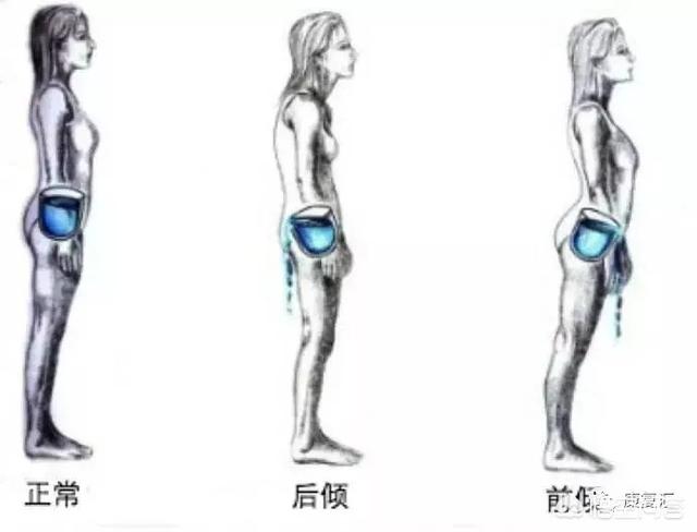 髋前倾该怎么康复？