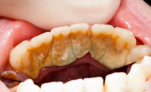 2,所以不是洗牙的错,是牙结石把牙齿围住了,三度松动很多轻轻的一拔就