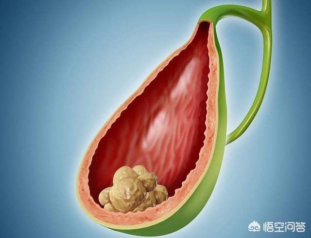 外科疾病总结:有哪些胆囊疾病呢？该怎样预防呢？