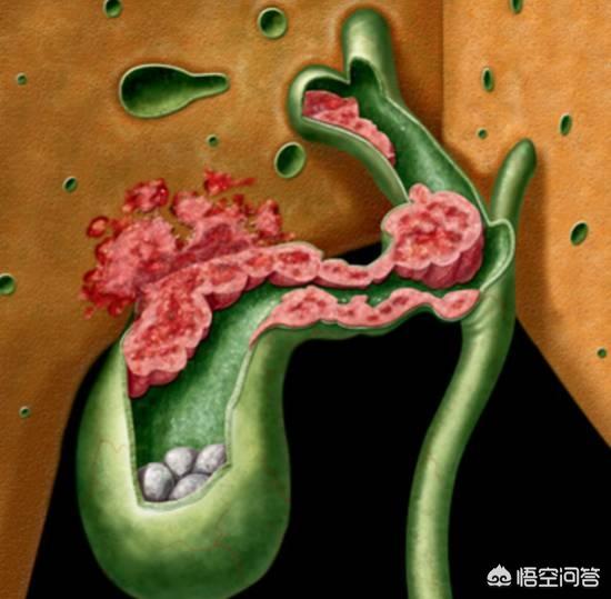 外科疾病总结:有哪些胆囊疾病呢？该怎样预防呢？