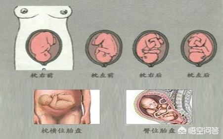 胎位b超多少钱:怎样发现胎位异常？胎位异常是否与胎儿的大小有关？