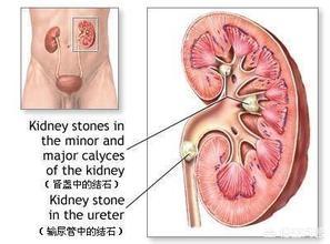 泌尿系统解剖图:肾结石为什么会自动下来？
