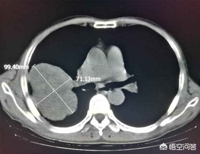 不影响寿命的十大癌症:人一旦被查出癌症，就一定会死吗？存活率有多高？ 不影响寿命的十大癌症乳腺癌