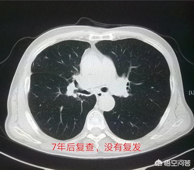 不影响寿命的十大癌症:人一旦被查出癌症，就一定会死吗？存活率有多高？ 不影响寿命的十大癌症乳腺癌