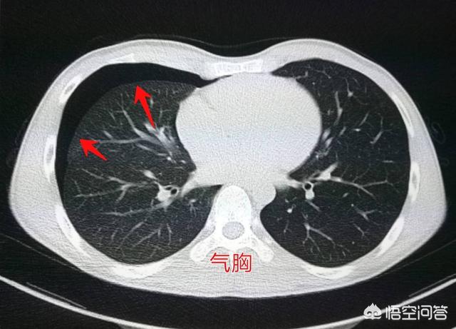 头条问答 肺大泡的症状有哪些 应该如何治疗 27个回答