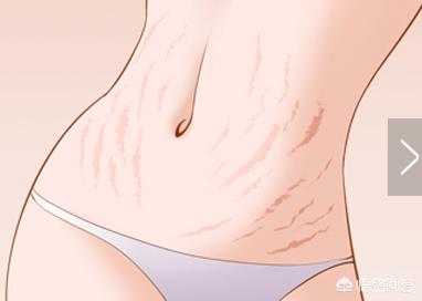 怀孕多久会长妊娠纹？为什么会长妊娠纹？插图22