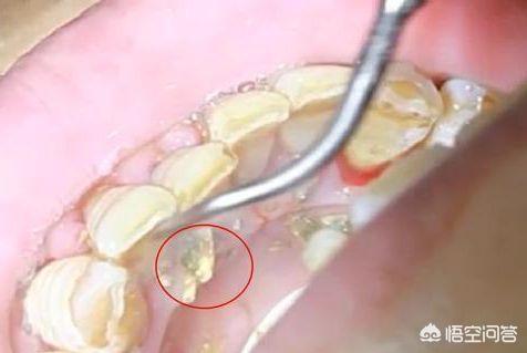 所谓的美牙师是如何炼成的，马洪刚的千术到底是如何炼成的