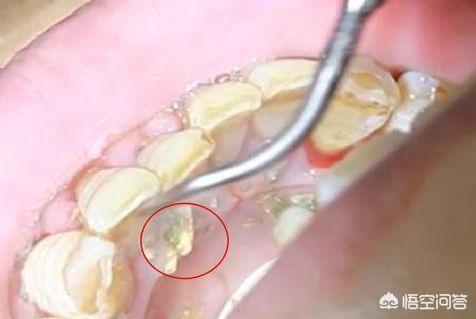 猫牙结石症状:牙结石是如何形成的？洗了牙之后要怎么做才能防止再长牙结石？