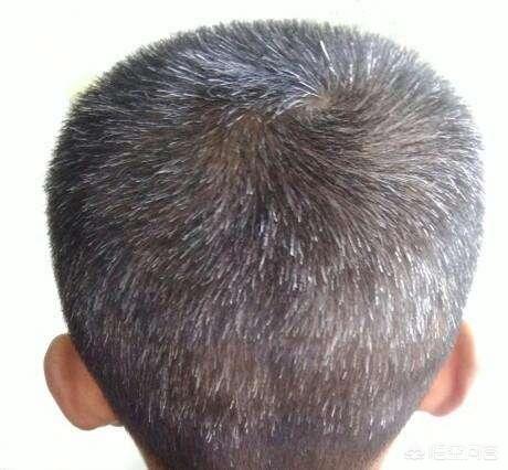 少年白怎么办,少年白怎么办能恢复吗