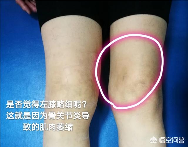 膝盖关节炎症状:怀疑膝关节炎如何自我检查？