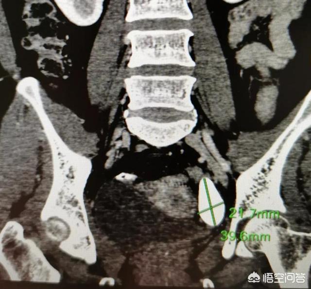 膀胱结石症状预防:肾结石或尿道结石有什么症状？