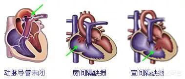 先天性心脏病的症状:先天性心脏病有哪几种？哪些是可以治愈的？