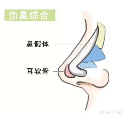 鼻综合手术拆线多少钱:鼻综合诊所拆线大概多少钱 鼻部整形中隆鼻和鼻综合整形具体有什么区别？