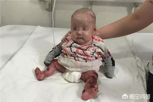 歌舞伎脸谱综合征:全中国有7000多种罕见病，你知道的有哪些？