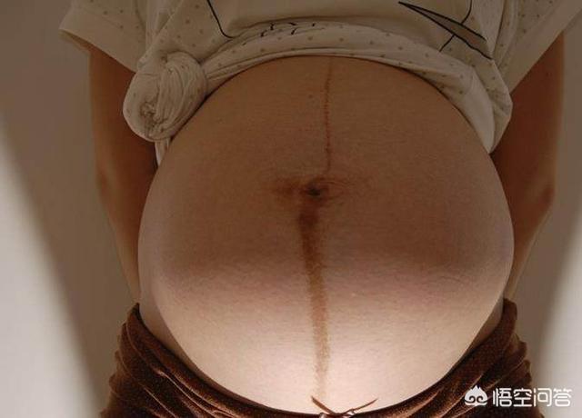 女生小肚子有条线是什么，准妈妈肚子上为啥会有妊娠线妊娠线会一直存在吗