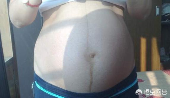 女生小肚子有条线是什么，准妈妈肚子上为啥会有妊娠线妊娠线会一直存在吗