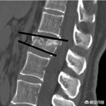 头条问答 压缩性骨折是什么意思 个回答